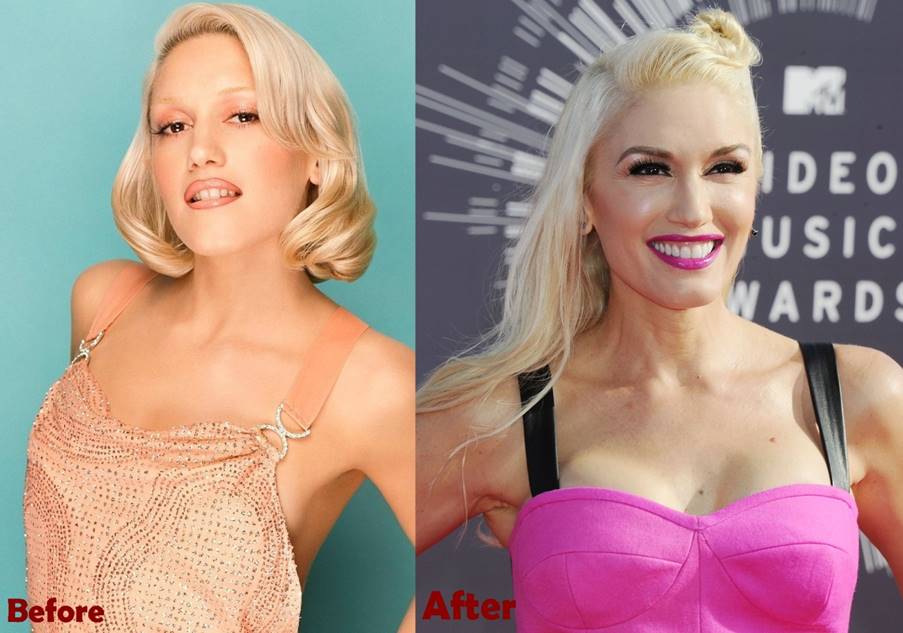 Look How Gwen Stefanis Plastic Surgery Has Helped Her Shift From Grunge To Glam Enc